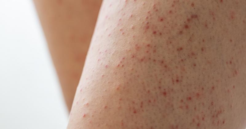 Ne nyomkodd, ha ilyet látsz a bőrödön: ez a jellegzetes dudor a keratosis pilarisra utal.